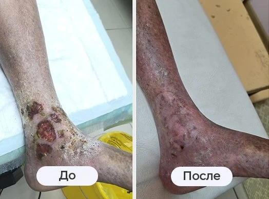 фотография до и после лечения трофической язвы, лазерного лечения варикоза в клинике Варикоза нет в Саратове