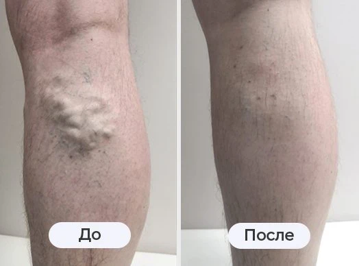 фотография до и после лазерного лечения варикоза в клинике Варикоза нет в Саратове