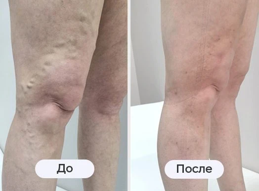 фотография до и после лазерного лечения варикоза в клинике Варикоза нет в Саратове